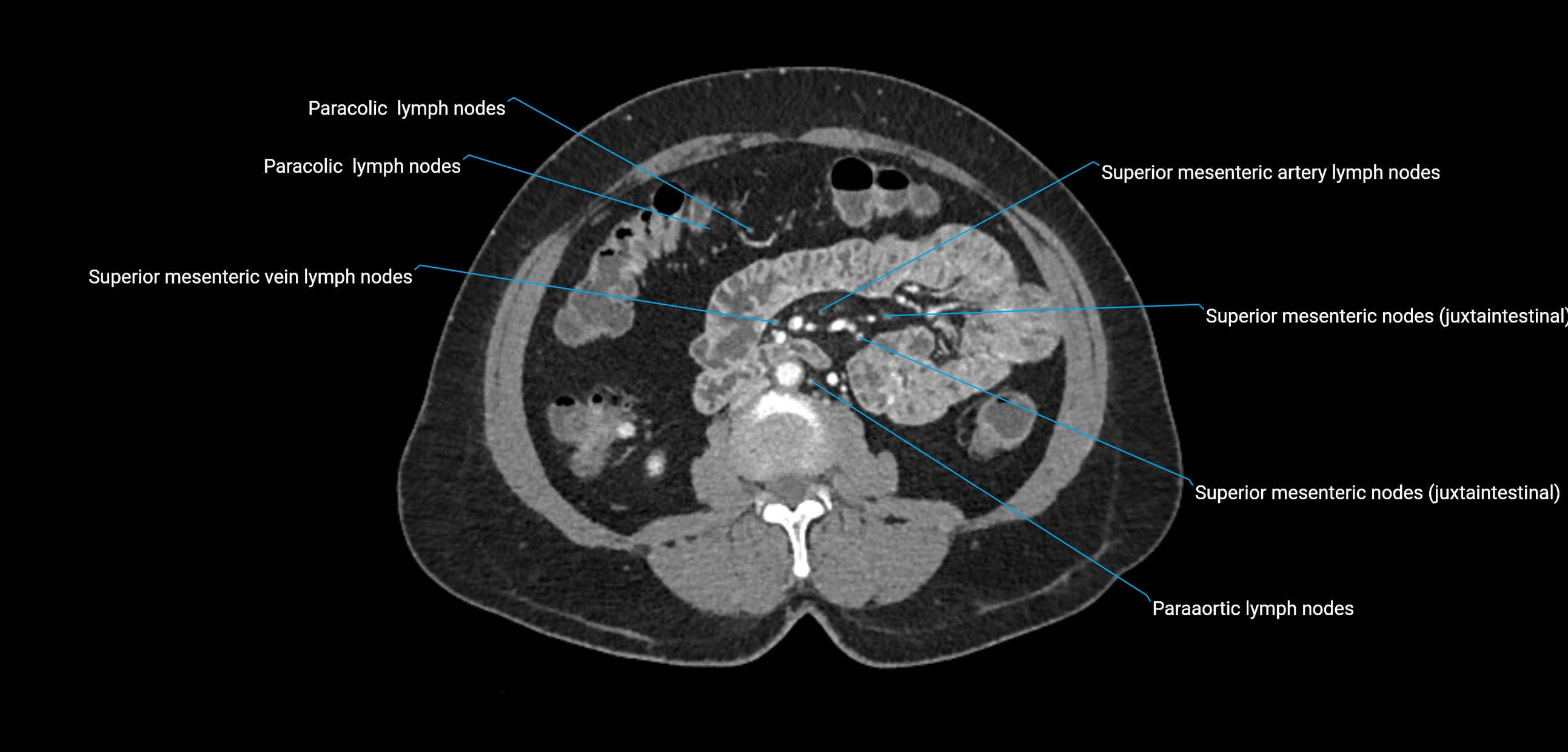 CT ct abdominal lymph nodes  axial cross sectional anatomy  enchanced radiology image -img-00002-00222.webp